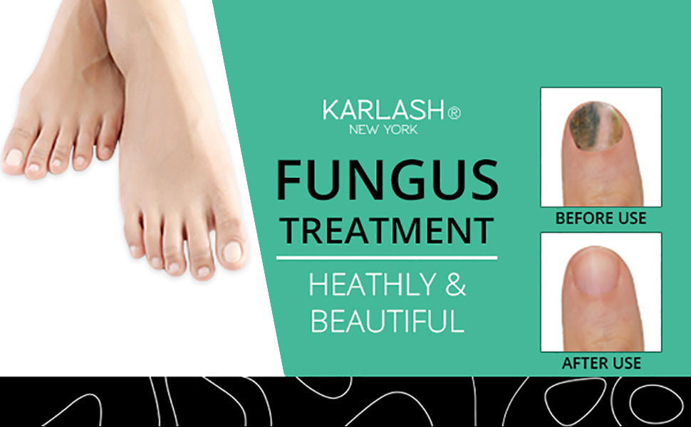 Karlash Finger & Toenail Fungus Remover Solution EXTRA STRONG